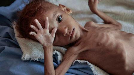 骨瘦如柴的图片,揭示贫困与饥饿的残酷现实